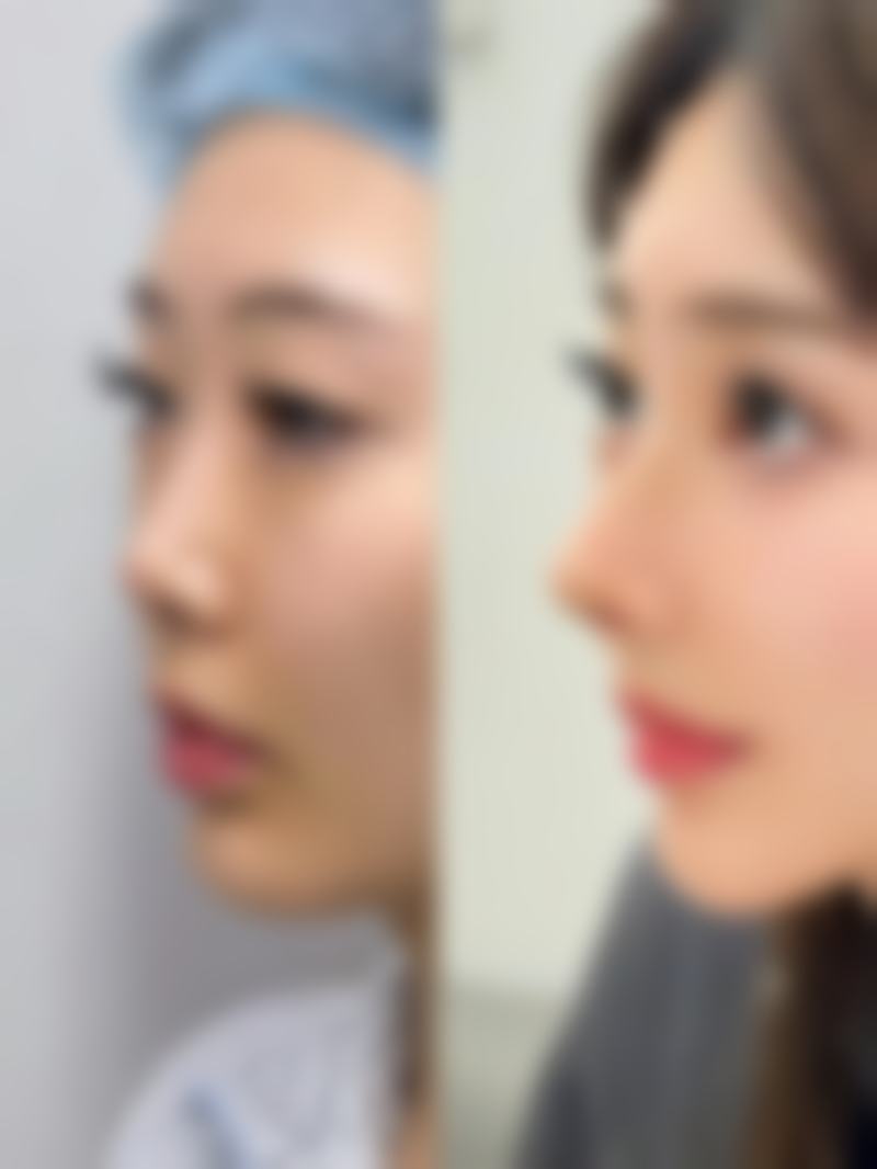 热玛吉和超声炮谁提升效果更胜一筹？从原理到成效深度剖析二者抗衰差异 