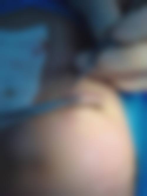 翁晓荣眼部综合整形实例