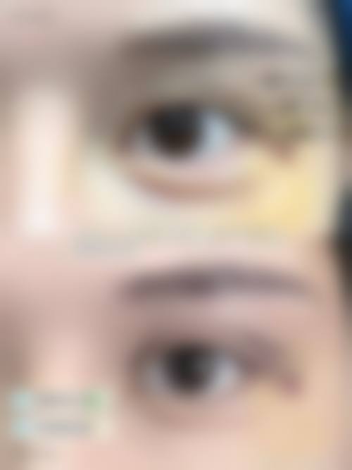 张建强面部年轻化手术实例