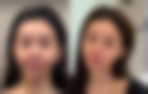 男士去眼袋大揭秘：非手术轻医美的神奇之处