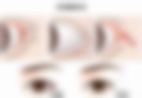刚做完双眼皮手术眼睑外翻会好转吗？多数轻度外翻3 - 6个月可改善，严重情况需评估修复