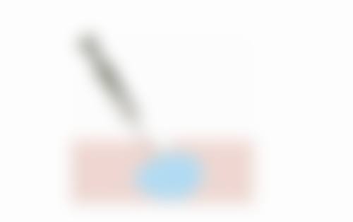 嗨体打泪沟成眼袋别慌！实例分享和注意事项