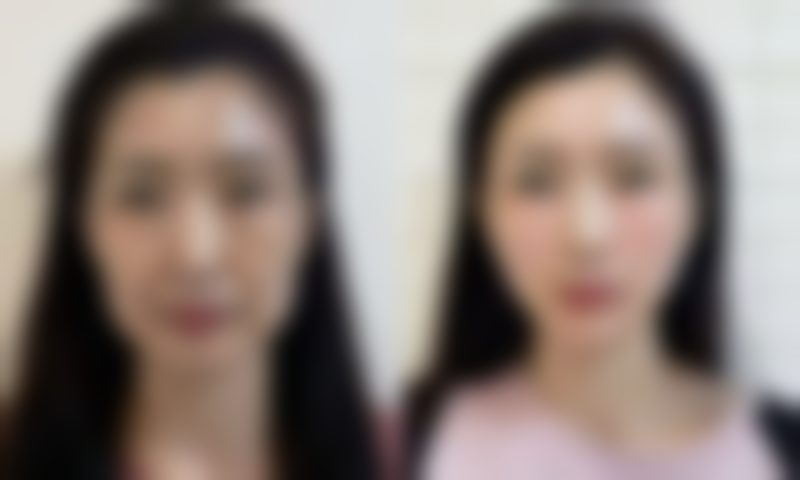 不同阶段修复情况，美鼻逐步成型