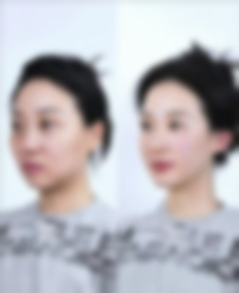 术后联合治疗：淡化修复成效好