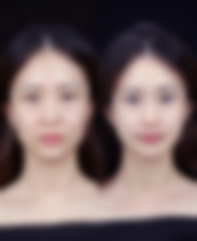 50岁女性隆胸:选正规医院特别重要