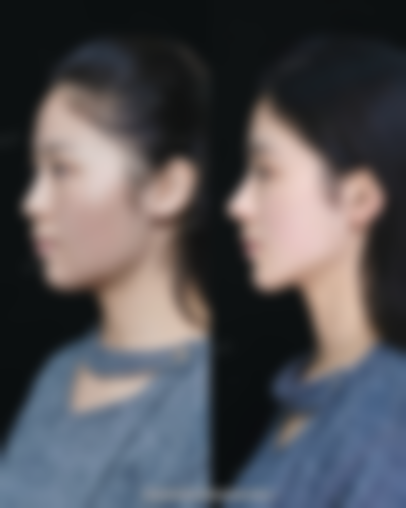 七、衣笠美容外科 難波价格表：（仅供参考）