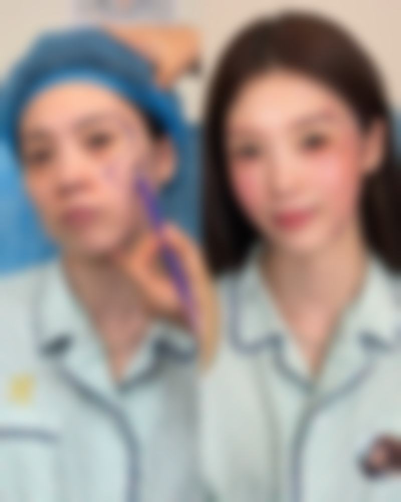 男士去眼袋大揭秘：非手术轻医美与手术切除方案，助你重拾眼部年轻光彩 