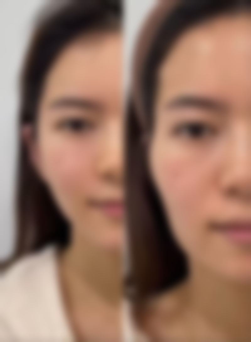 拯救双眼皮下垂难题！双眼皮手术来助力