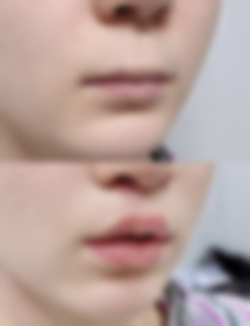 50岁女性隆胸:术式选择有讲究