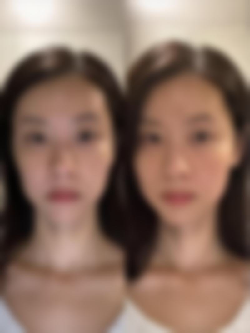 如何效率高修复疤痕?激光治疗优势多,精细修复有保护