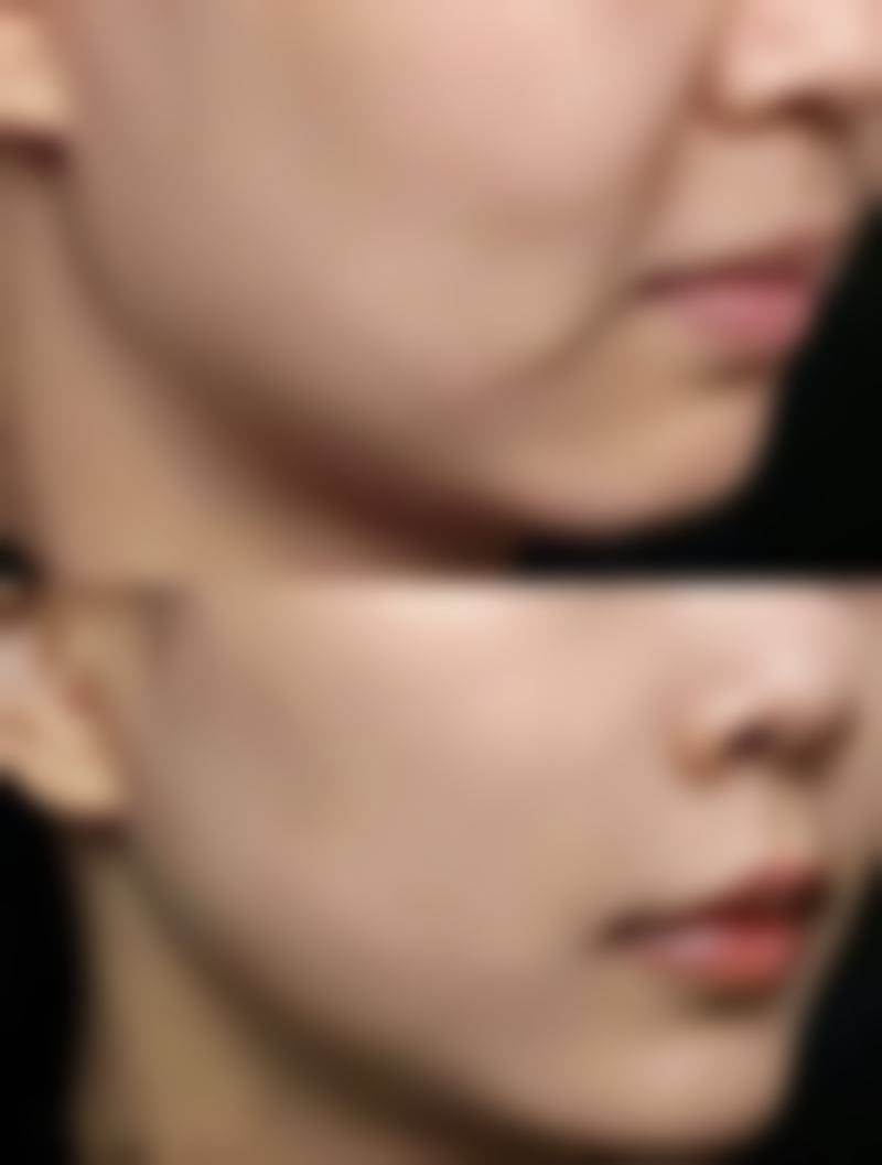 如何快速去除眼袋?选对医院特别重要