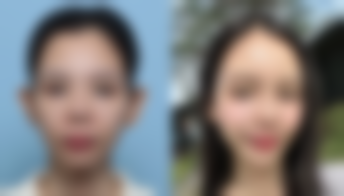 如何效率高修复双眼皮疤痕?依疤痕类型选手术或护理,精细修复有保护