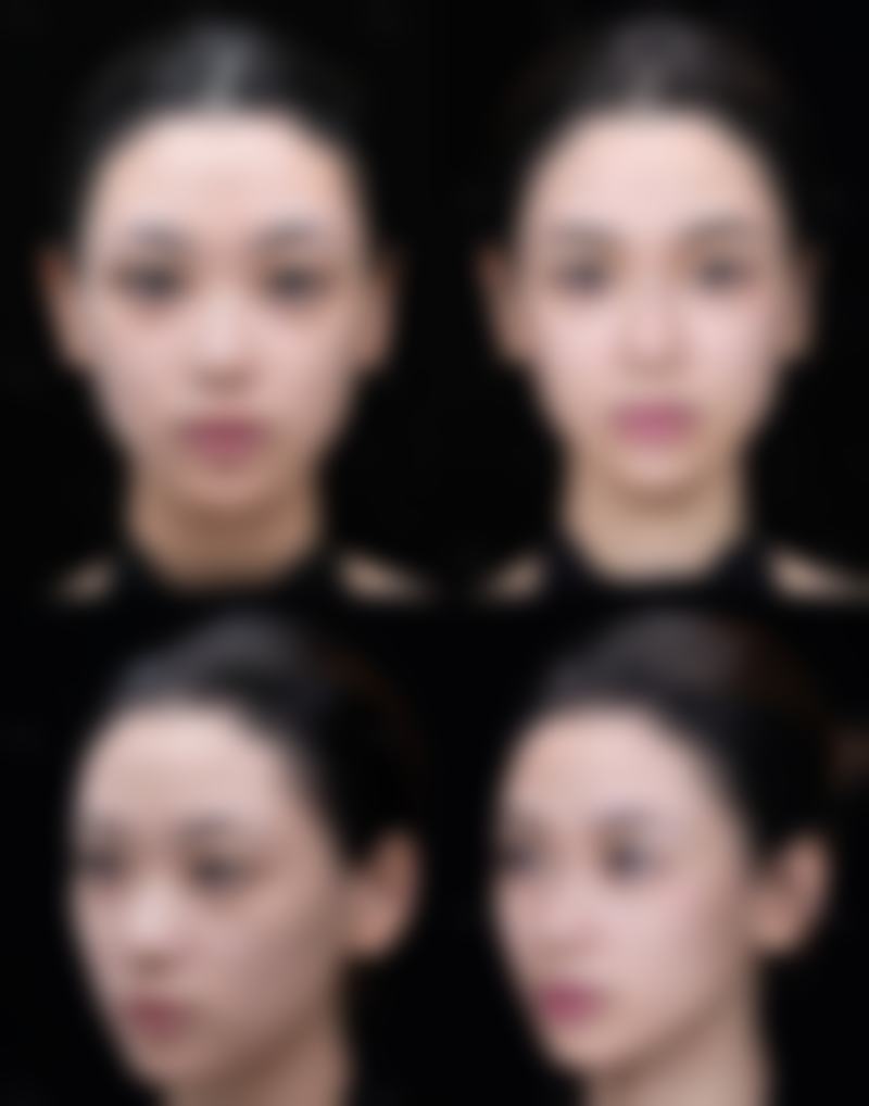 黑眼圈眼袋用啥滴眼液？医美干预显身手