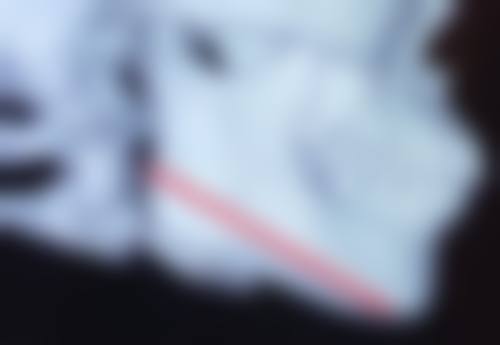 额头有疤痕不知咋办？按疤痕类型选医美方案，3-6个月显著改善外观 