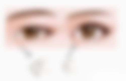 想摆脱疤痕疙瘩?激光治疗有奇效