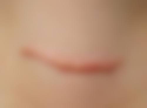 冯少清复杂瘢痕畸形修复实例