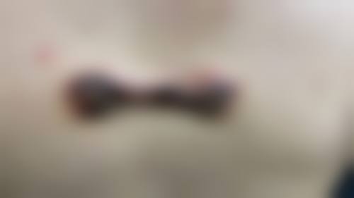 冯少清复杂瘢痕畸形修复实例