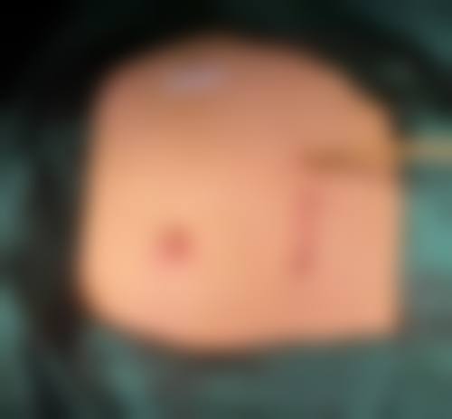 冯少清复杂瘢痕畸形修复水平怎么样可靠吗？