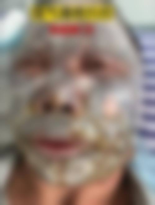 冯少清复杂瘢痕畸形修复实例