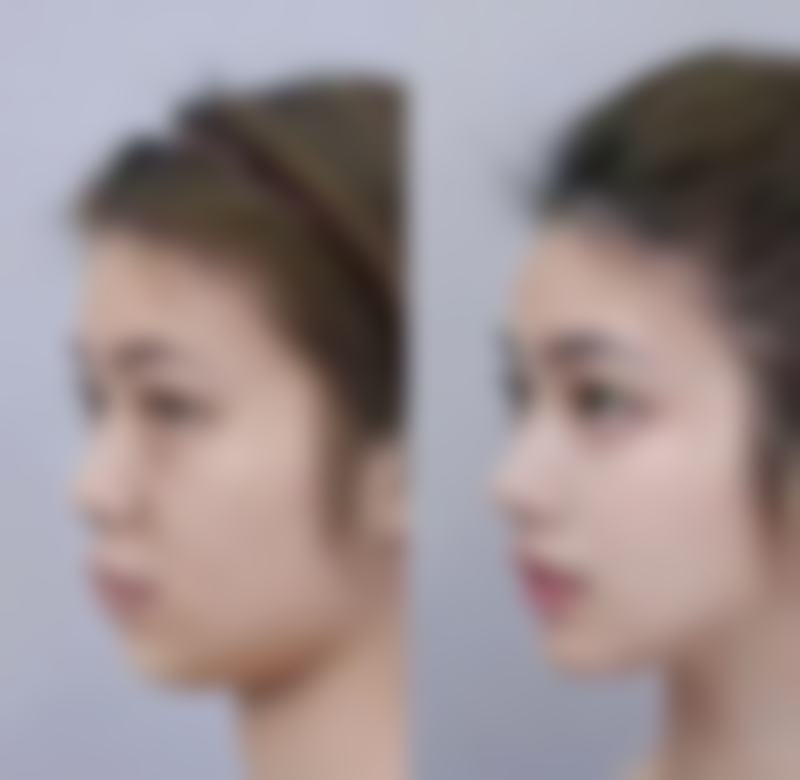 想去除疤痕疙瘩?物理治疗显身手