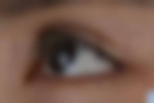 选择靠谱的医院做激光去眼袋