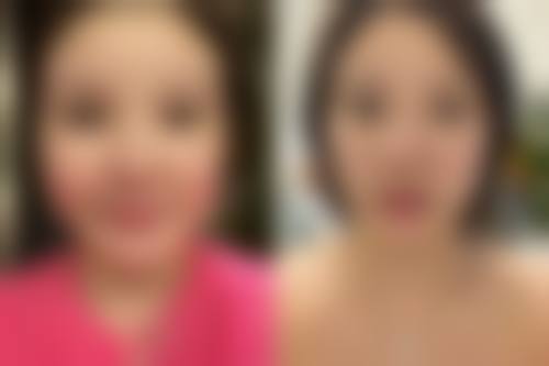 骨膜贴片隆鼻的价格和术后护理