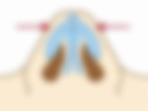 消除眼袋妙招大公开：选对治疗方案，成效立竿见影