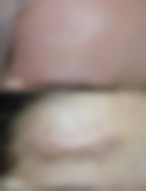 冯少清复杂瘢痕畸形修复实例