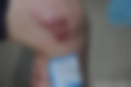 冯少清复杂瘢痕畸形修复水平怎么样可靠吗？