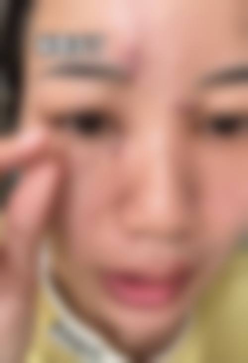 冯少清复杂瘢痕畸形修复水平怎么样可靠吗？