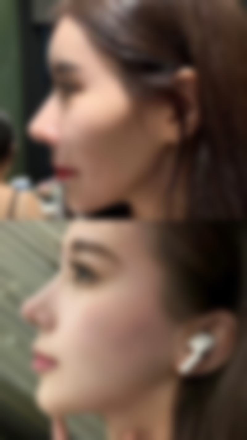 抽脂抽出的脂肪能带走吗？影响脂肪再利用的因素