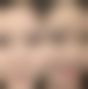 去眼袋手术护理大攻略：做好护理，修复加速