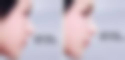 靠谱医院助力抽脂，远离反弹烦恼