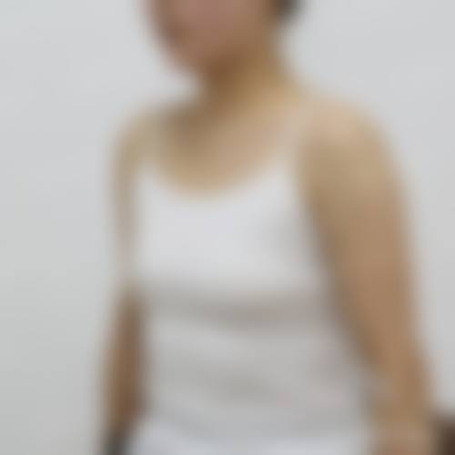 吕红卫胸部整形实例