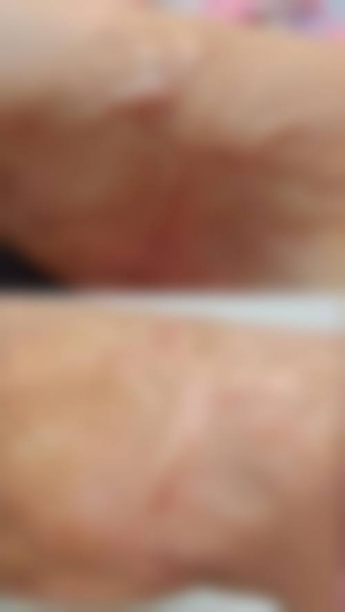 冯少清复杂瘢痕畸形修复水平怎么样可靠吗？