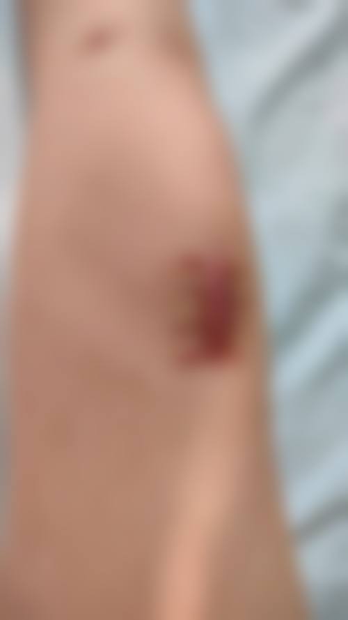 冯少清复杂瘢痕畸形修复实例