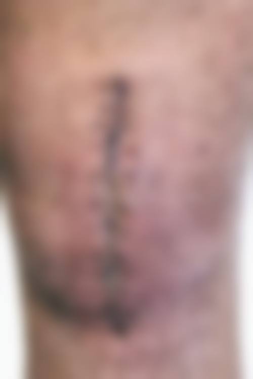 冯少清复杂瘢痕畸形修复实例