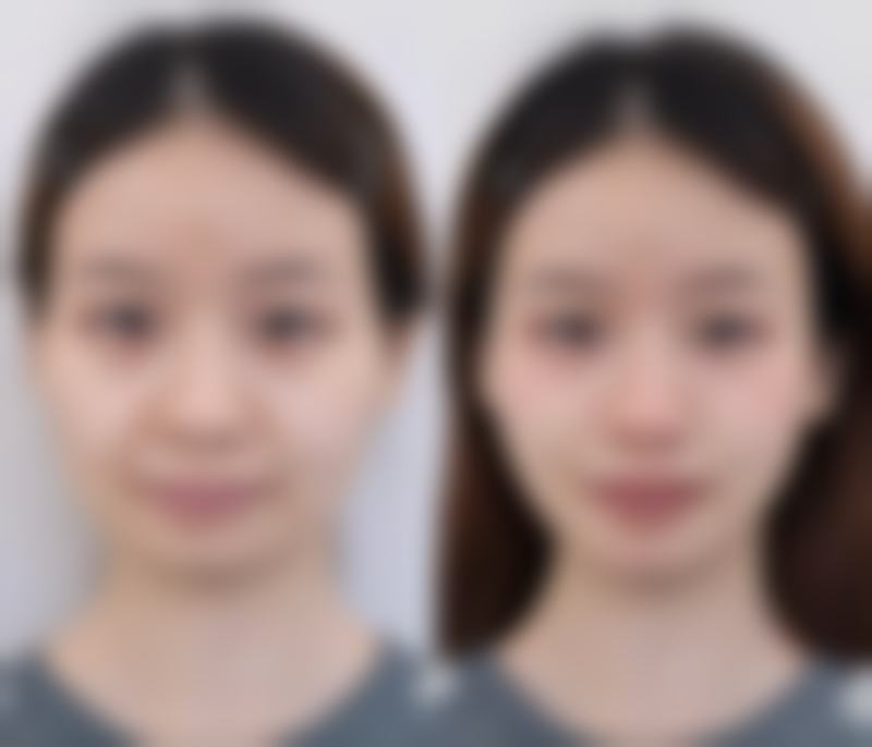 热油烫伤留疤别发愁！多种治疗手段助你淡化疤痕，专业医院为美护航 