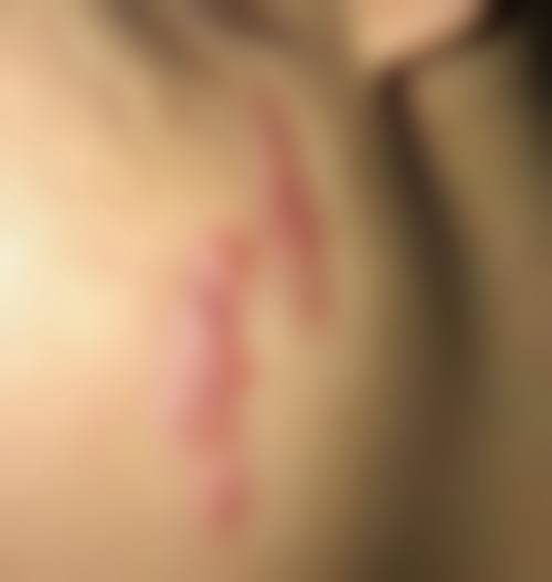 冯少清复杂瘢痕畸形修复实例