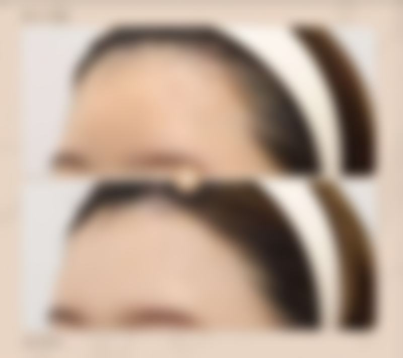 脸部吸脂能长效瘦脸吗？减少脂肪，成效持久稳定