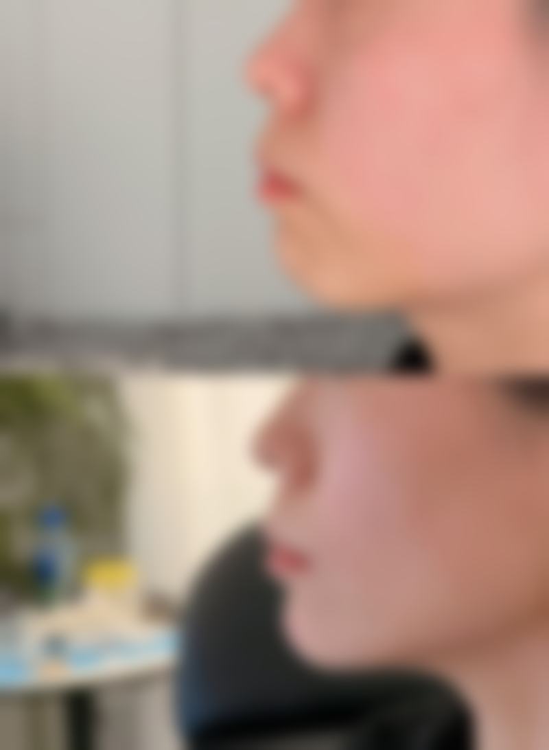 VE外用涂抹法，简单操作成效好