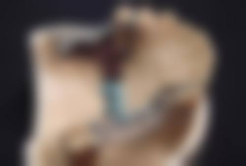 开扇型双眼皮:选择与术后护理