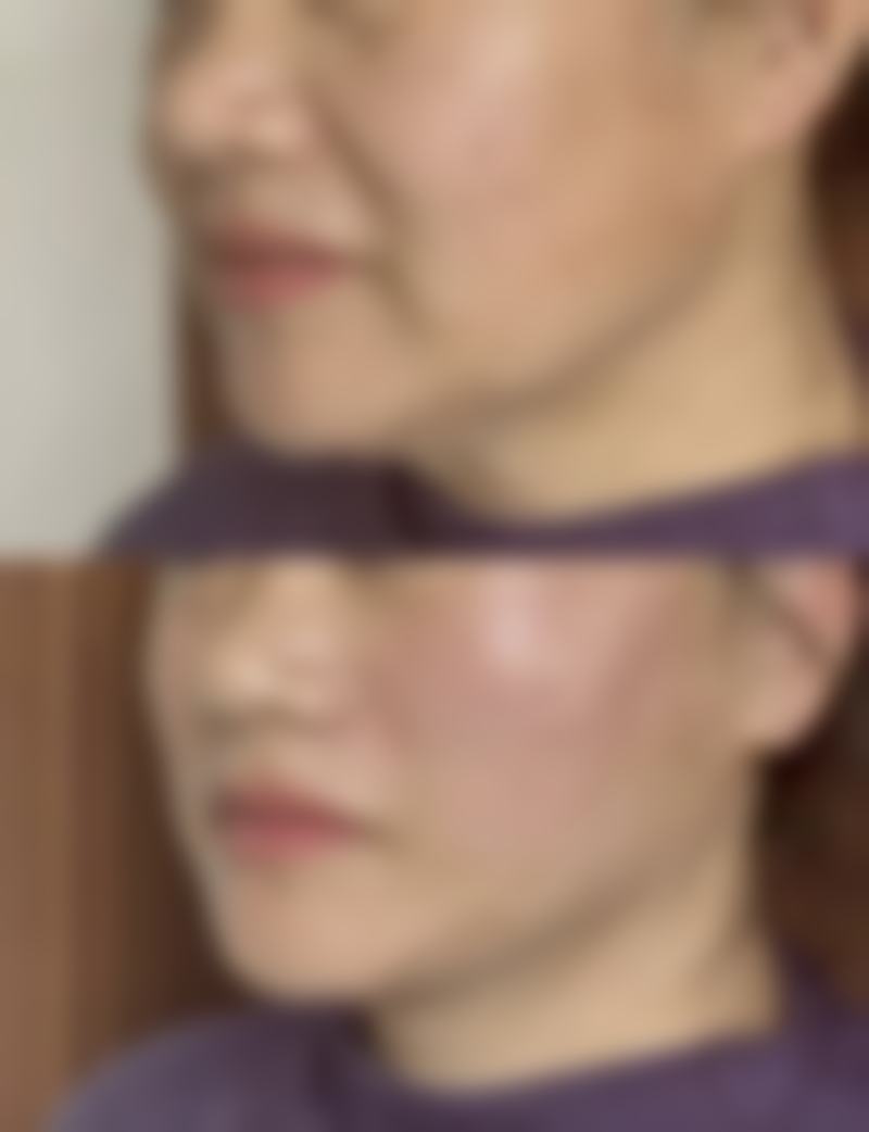 6个月以上间隔对脂肪存活和胸部形态塑造的好处