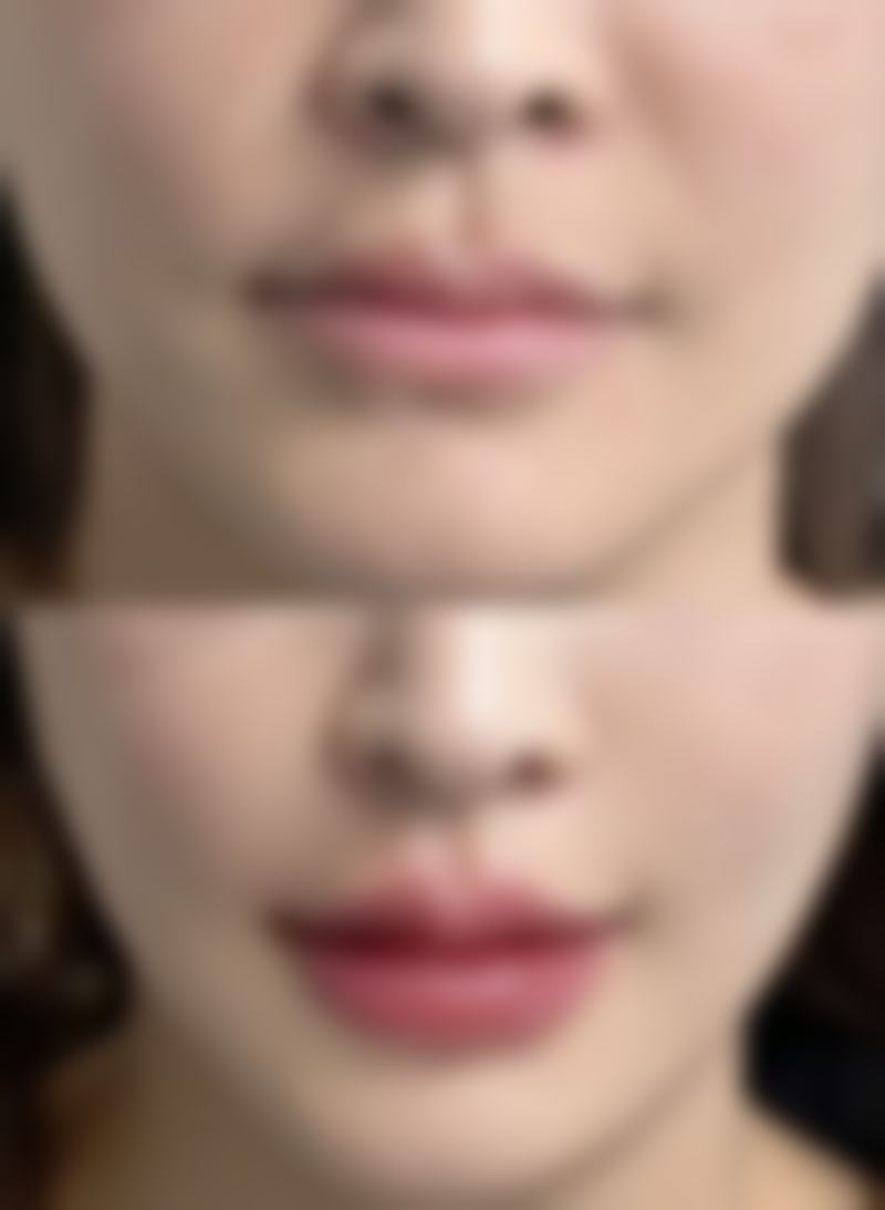 隆胸后长期形态会发生哪些变化?