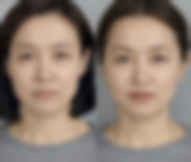 自体脂肪隆胸二次手术间隔多久为宜？6 个月以上更利脂肪存活与胸部形态塑造