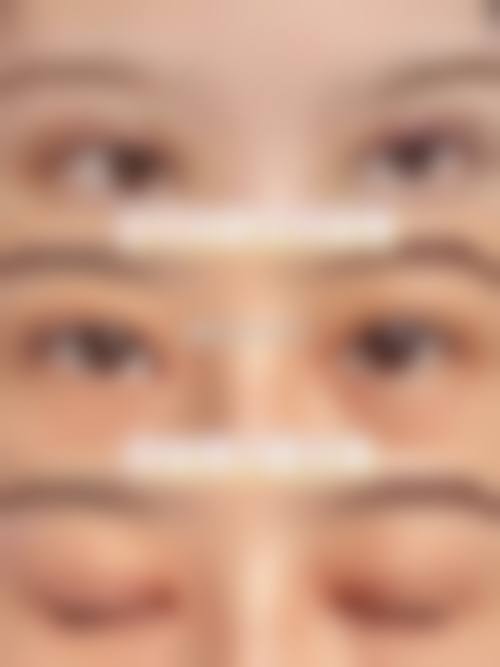 郝霞眼部整形实例