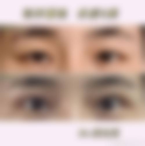 郝霞眼部整形水平怎么样可靠吗？