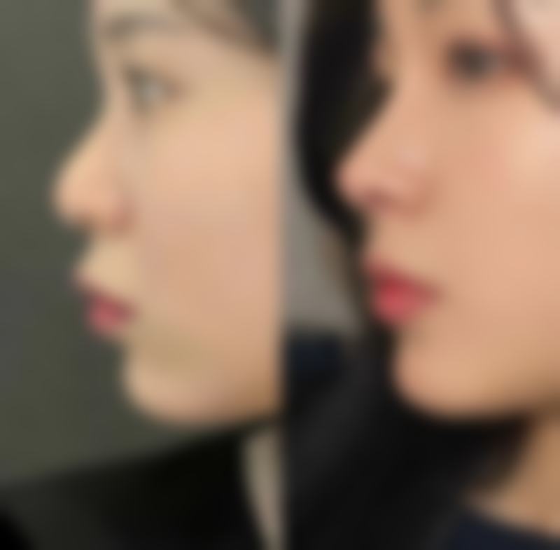 一岁宝宝双眼皮变单眼皮咋回事？总结与安心之语