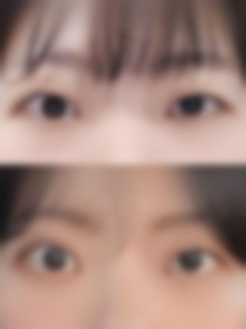 郝霞眼部整形实例