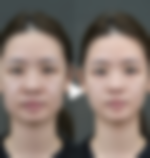 脸上冻伤疤痕去除有诀窍：日常科学护理不可少